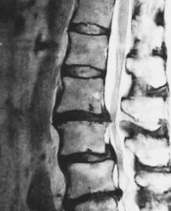 ワイズ接骨院･整体院の脊柱管狭窄症画像