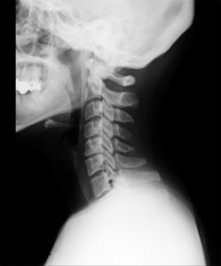 ワイズ接骨院･整体院の頸椎レントゲン画像